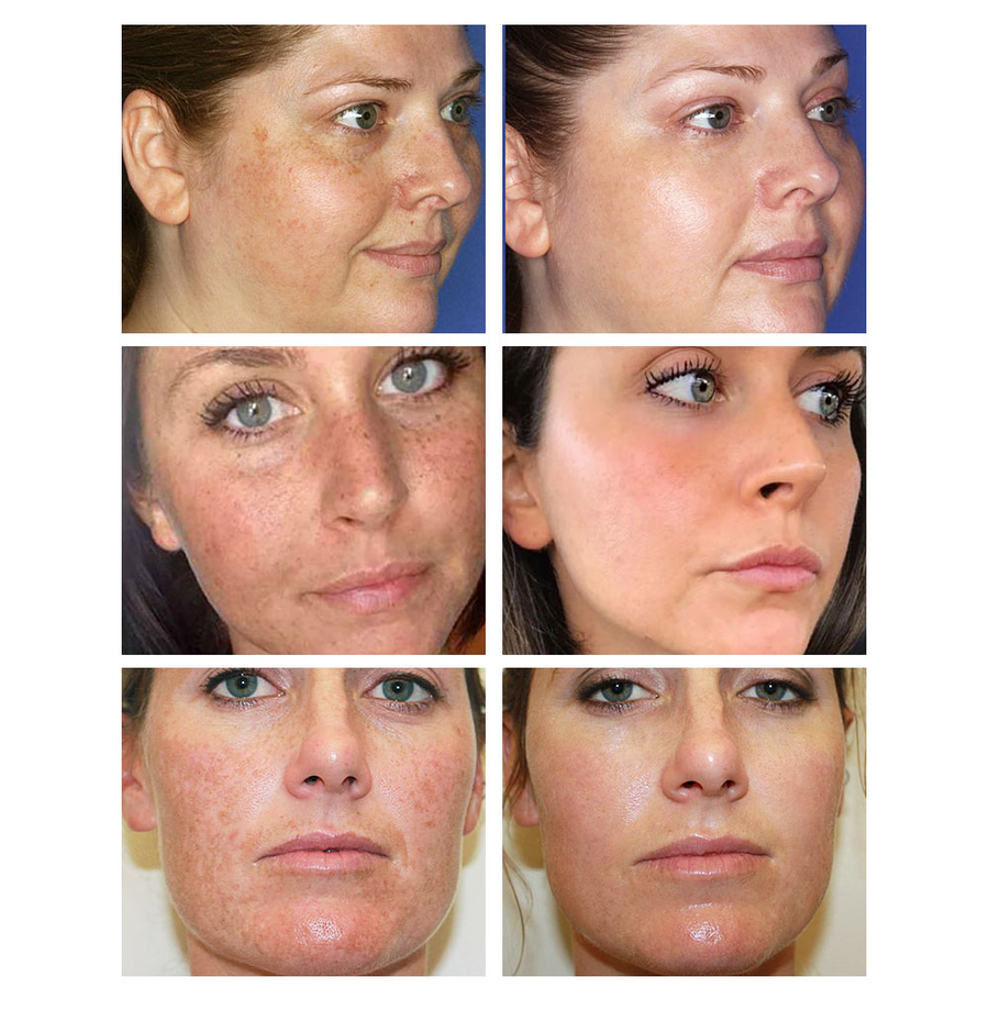 10% Niacinamide Spots Removal Serum 🎉Second Item half price🎉