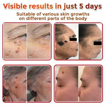 🔥Buy 1 Get 1 Free🔥Pain-free Bee Venom Wart and Tags Removoal Cream