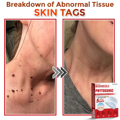 MicroNeedle Botanic Skin Tag Removal Patch ✅Australian Made