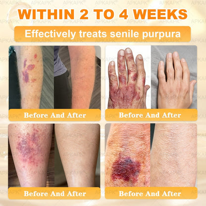 Official Store | 𝐀𝐏𝐊𝐀𝐏𝐊® 𝟖-𝐈𝐧-𝟏 𝐁𝐞𝐞 𝐕𝐞𝐧𝐨𝐦 & 𝐓𝐚𝐥𝐥𝐨𝐰 𝐒𝐤𝐢𝐧 𝐅𝐢𝐫𝐦𝐢𝐧𝐠 & 𝐓𝐫𝐞𝐚𝐭𝐦𝐞𝐧𝐭 𝐂𝐫𝐞𝐚𝐦 (Effective Within 7 Days)Bee Venom + Tallow · 7X Deep Hydration, targets wrinkles, sagging, stretch marks, dark spots, purpura, inflammations and more