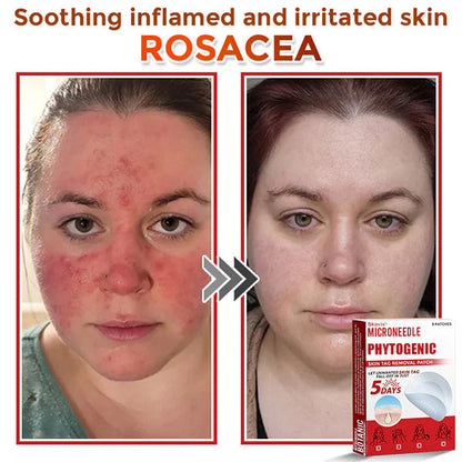 MicroNeedle Botanic Skin Tag Removal Patch ✅Australian Made