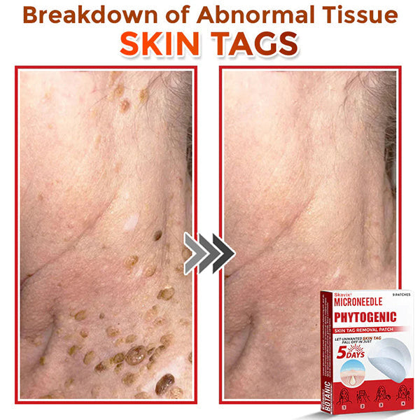 MicroNeedle Botanic Skin Tag Removal Patch ✅Australian Made