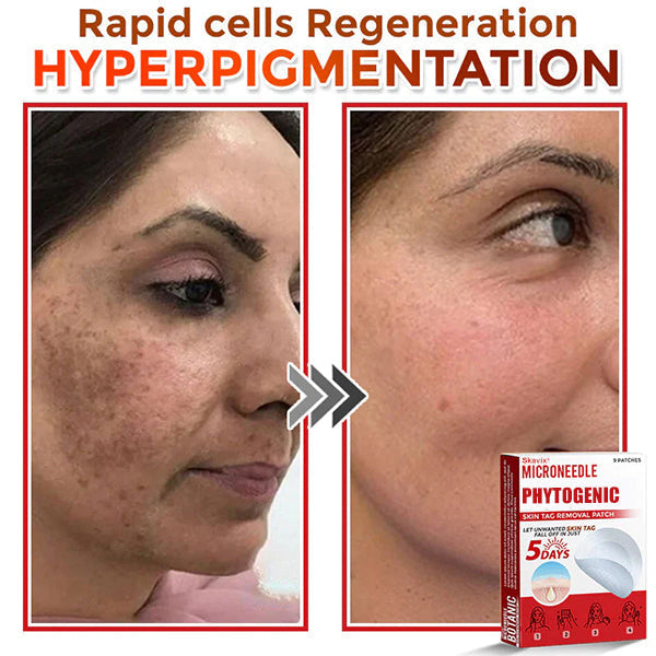 MicroNeedle Botanic Skin Tag Removal Patch ✅Australian Made