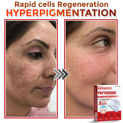 MicroNeedle Botanic Skin Tag Removal Patch ✅Australian Made