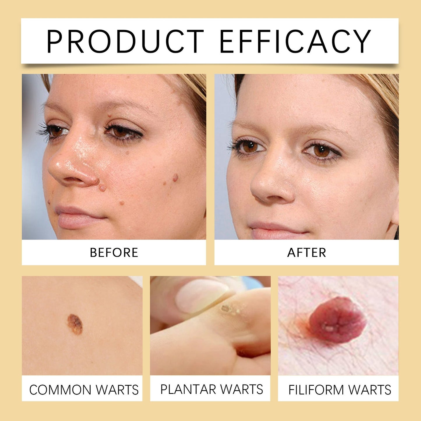 🔥Buy 1 Get 1 Free🔥Pain-free Bee Venom Wart and Tags Removoal Cream